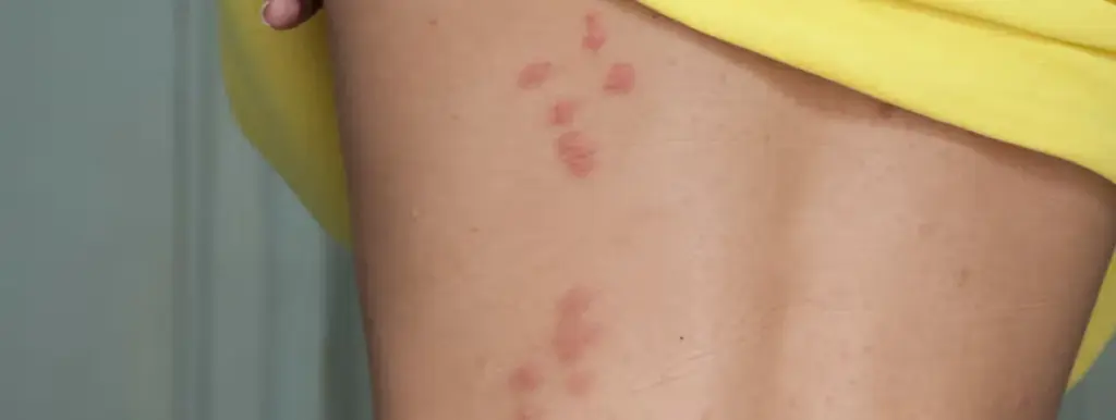 Bed Bug Bites